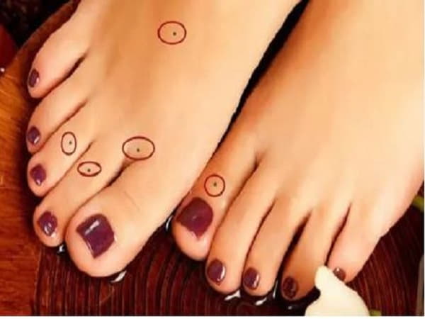 Ảnh hưởng của nốt ruồi ở ngón chân về cuộc sống