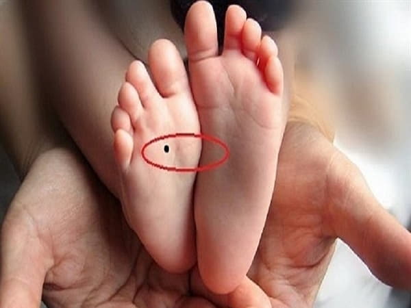 Ý nghĩa của nốt ruồi trong lòng bàn chân