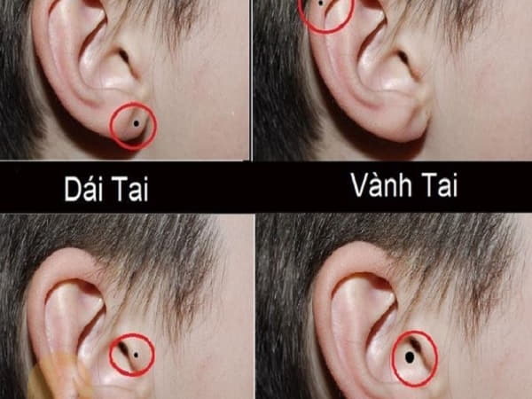 Nốt ruồi ở gần tai có ý nghĩa gì?