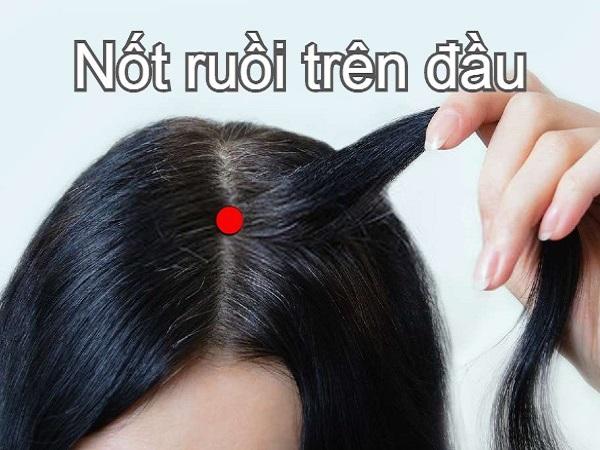 Nốt ruồi trên đầu ở vị trí phía trước đầu (trán)