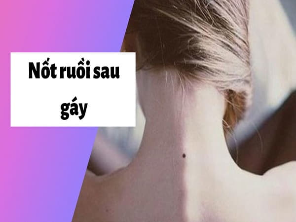 Quan niệm chung về nốt ruồi sau gáy