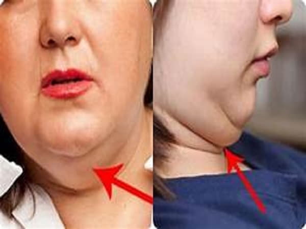 Tướng người có nọng cằm về sự nghiệp