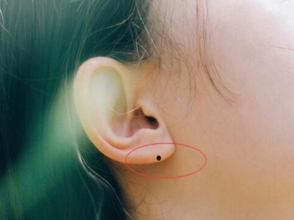 Ý nghĩa chung của nốt ruồi ở dái tai