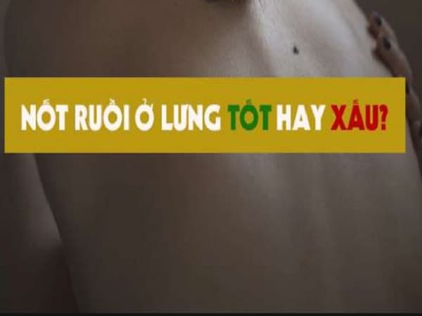 Nốt ruồi sau lưng tốt hay xấu?