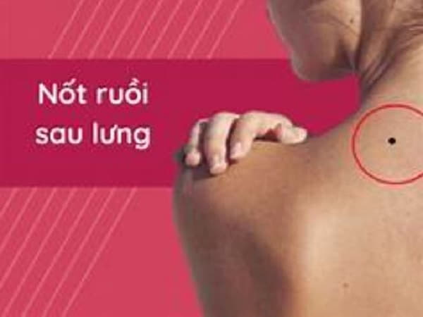 Nốt ruồi sau lưng có ý nghĩa gì?