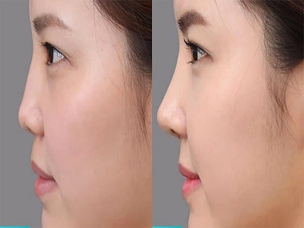Ảnh hưởng của tướng mặt tròn mũi tẹt đến cuộc sống và tình duyên