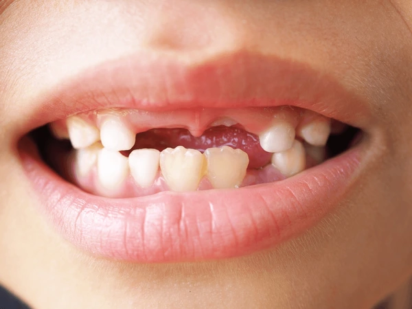 Giải mã bí ẩn nằm mơ thấy bị rụng răng có ý nghĩa gì?